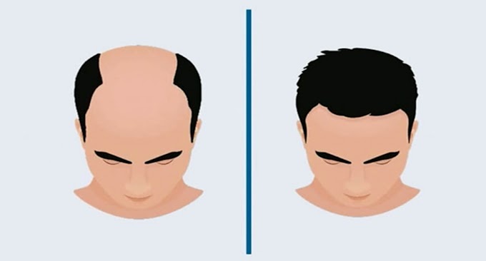 Hair Transplants: Costs and Types