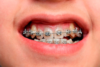 Niềng răng mắc cài kim loại cho trường hợp nào?