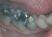 amalgam filling or white filling milton keynes dentist