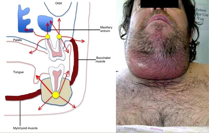 PDF: A Guide to Deep Neck Space Fascial Infections for the Dental Team