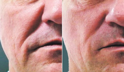 Laser Skin Tightening