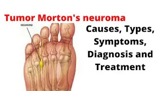 What Is Morton's Neuroma