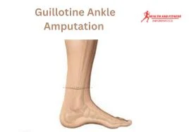 Guillotine Ankle Amputation
