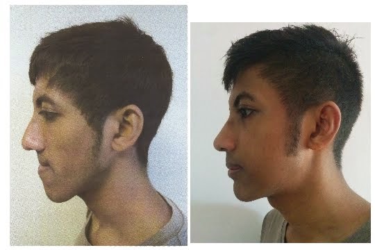 Double Jaw Surgery From Malaysia to Singapore: Cost/Insurance coverage