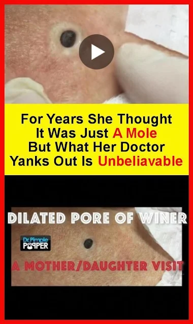 For Years She Thought It Was Just A Mole, But What Her Doctor Yanks Out Is Unbeliavable