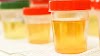 Can You Drink Your Own Urine? | Drinking Urine is Good?
