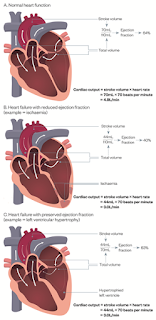 Treatment of CHF