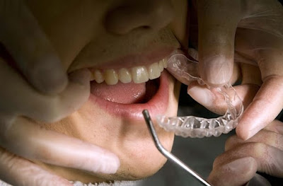 Tìm hiểu phương pháp niềng răng không mắc cài là gì-1