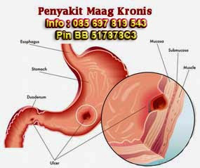 Cara Mengobati Maag Kronis Paling Ampuh dan Aman