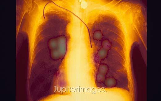 lung cancer