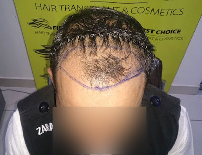 First Choice hair transplant surgery