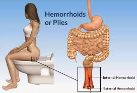 Penyebab hemorrhoid