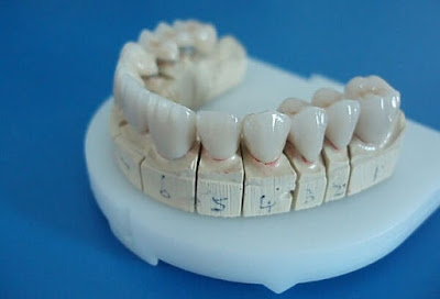 Có bao nhiêu loại cầu răng sứ?