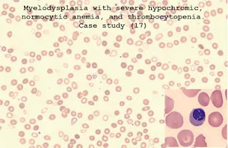 Case study (17)- Myelodysplasia with severe hypochromic, normocytic anemia, and thrombocytopenia.