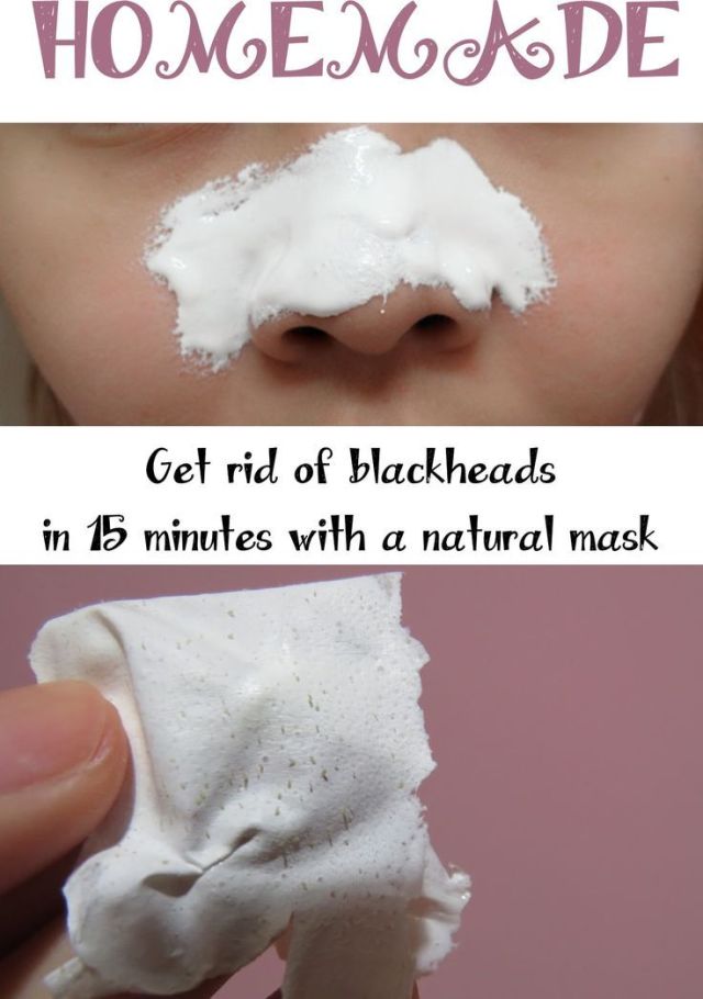 Get Rid Of Blackheads In 15 Minutes With A Natural Mask