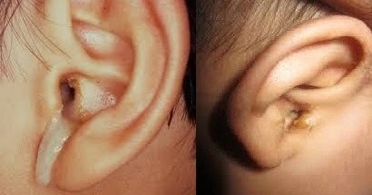 Pengobatan Herbal Obat untuk Telinga berkerak dan berair 