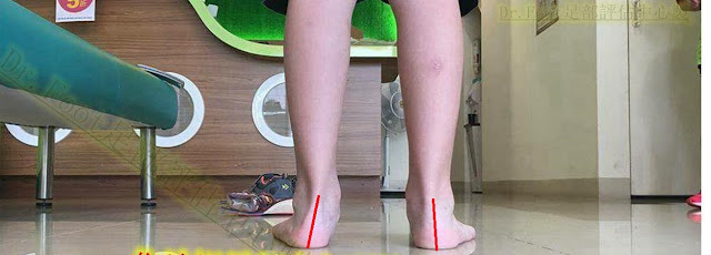 走路內八.內八矯正.扁平足矯正.足弓問題.足弓疼痛.腳底疼痛.腳跟疼痛.腳掌疼痛.足底筋膜炎.腳底筋膜炎.鞋墊.矯正鞋墊.足弓鞋墊.量身訂製鞋墊.高足弓.抽筋.小腿痠痛.小腿緊.無法久站.久走.矽膠鞋墊.氣墊鞋.軟鞋墊.專業鞋墊.推薦.高雄.屏東.台東.左營.鳳山.台中.彰化.桃園.苗栗.新北.新竹.澎湖 (4) 走路內八.內八矯正.扁平足矯正.足弓問題.足弓疼痛.腳底疼痛.腳跟疼痛.腳掌疼痛.足底筋膜炎.腳底筋膜炎.鞋墊.矯正鞋墊.足弓鞋墊.量身訂製鞋墊.高足弓.抽筋.小腿痠痛.小腿緊.無法久站.久走.矽膠鞋墊.氣墊鞋.軟鞋墊.專業鞋墊.推薦.高雄.屏東.台東.左營.鳳山.台中.彰化.桃園.苗栗.新北.新竹.澎湖 (4)