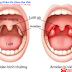 Viêm amidan và triệu chứng  