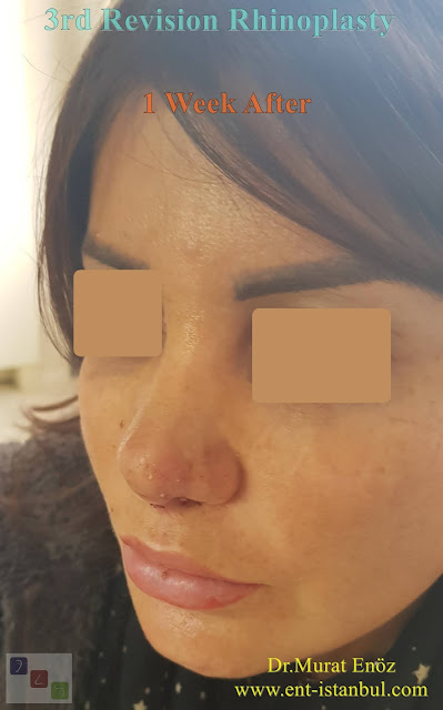 1 week after - 3rd Revision Rhinoplasty - Nostril Stenosis and Pollybeak Deformity - Complication Nose Surgery