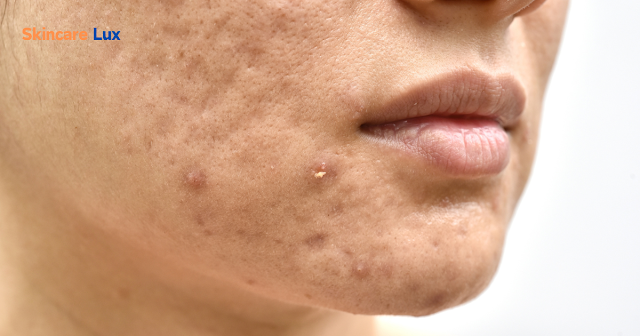  How to get rid of acne scars in 3 days