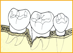 <Img src ="Recolonización-de-la-bolsa.gif" width = "1054" height "762" border = "0" alt = "Bolsas periodontales | Recolonización">