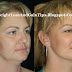 Face Exercises - Reduce/Lose Cheek Fat in 4 Week