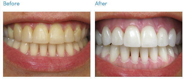  Dental Group: Do teeth-bleaching products really weaken your teeth