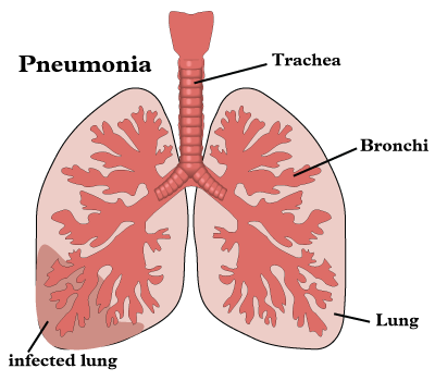 NursingCarePlanIneffectiveAirwayClearancerelatedtoPneumonia