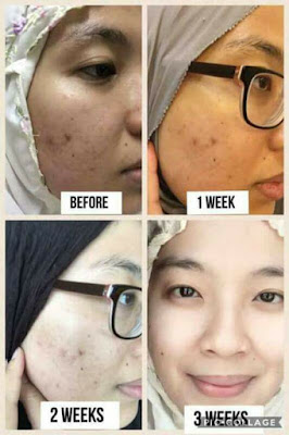 Testimoni Kulit Berseri Dan Anjal Dengan Produk Shaklee