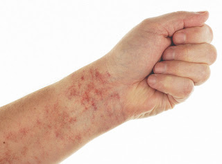 It is one of the rash occured along with the fever