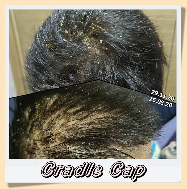 TSW Cradle Cap