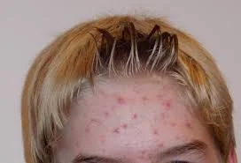 Celebrities With Acne