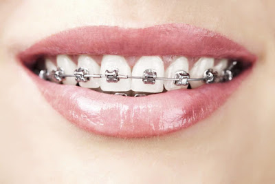 Cách nào khắc phục răng móm?