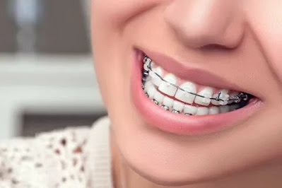 Best Lingual Braces in Melbourne