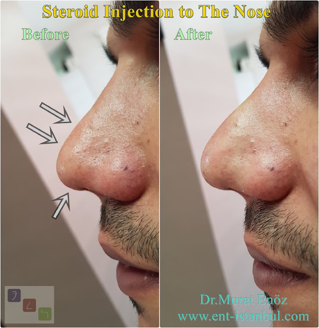 Steroid injection after rhinoplasty