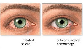 Causes of Bloodshot Eyes – Symptoms of Red Eyes