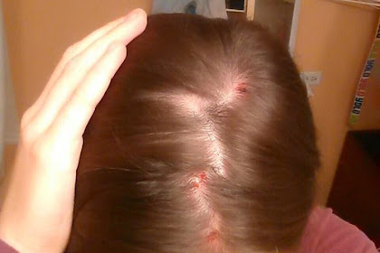 Scalp Acne 