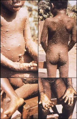 Criança afetada com monkeypox.