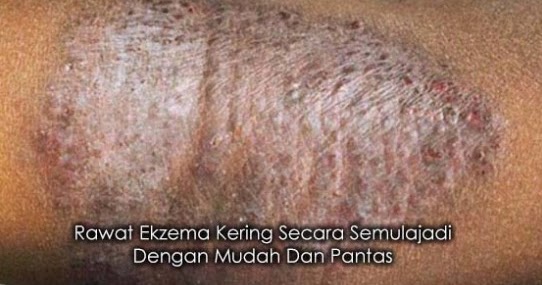 Penyakit Psoriasis,Ekzema,Ruam Bayi Dan Semua Penyakit 