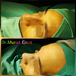 Nasal valve collapse,Alar collapse,Septorhinoplasty in istanbul,Rhinoplasty in men Turkey,