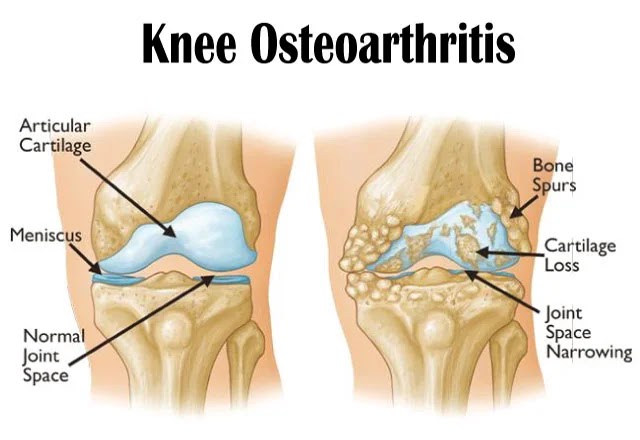 Knee Osteoarthritis: Symptoms and Physical Therapy Treatment