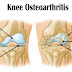  Knee Osteoarthritis: Symptoms and Physical Therapy Treatment