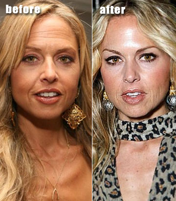 Rachel Zoe before and after plastic surgery, brow lift and botox?