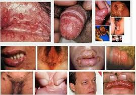 Harga Obat Sipilis Asli