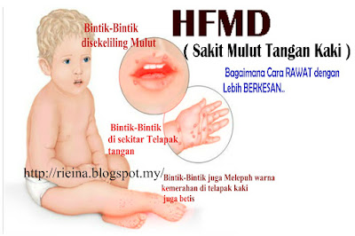 HFMD