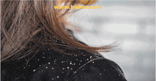 Treatment Of Bad Dandruff In Hair