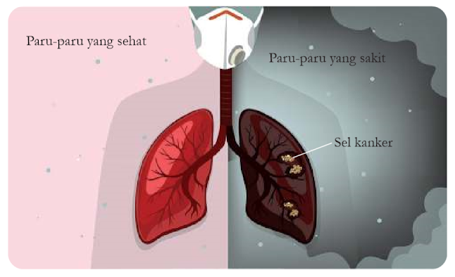 Perbandingan antara paru-paru yang sehat dengan yang terkena kanker