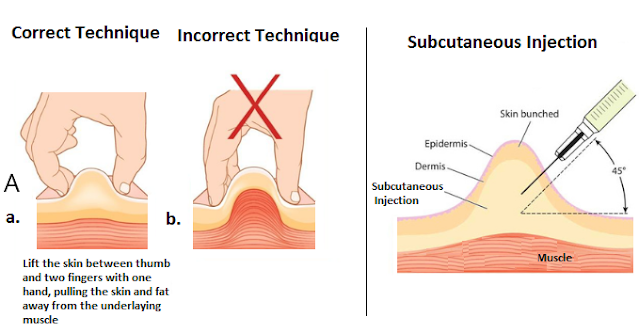 subcutaneous injection sites