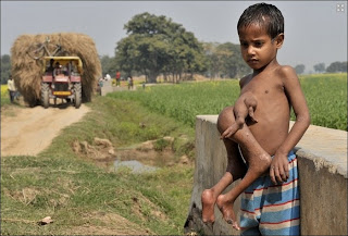 Fetus In Fetus, Parasitic Twin, Deepak Paswan