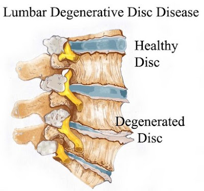 Degenerative Disc Disease Pictures